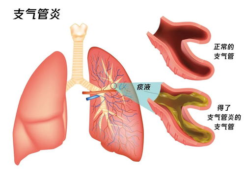支气管炎怎么疏通气管道(支气管炎疏通什么经络)