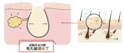 管道疏通毛孔大怎么办(管道疏通毛孔大怎么办小妙招)