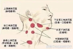 淋巴太堵了怎么疏通管道(淋巴太堵了怎么疏通管道呢)