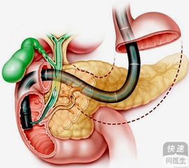 怎么疏通管道血管通畅呢(怎么能疏通血管有什么好处) 怎么疏通管道血管通畅呢(怎么能疏通血管有什么好处)