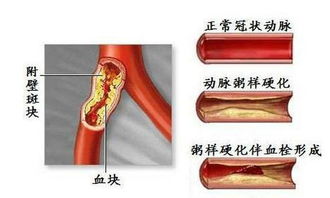怎么疏通管道血管堵塞了(怎样疏通血管堵塞) 怎么疏通管道血管堵塞了(怎样疏通血管堵塞)