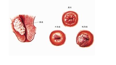 血瘤怎么疏通血液管道(血瘤用什么治最好)