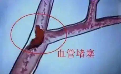 怎么疏通管道血管堵塞呢(怎么疏通管道血管堵塞呢图片)