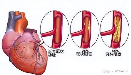 远端管道堵塞怎么疏通(远端血管堵后果严重吗)