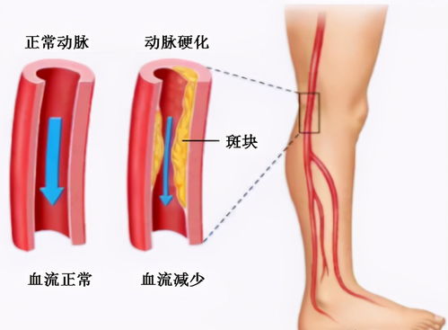 怎么疏通管道血管通畅(怎么能疏通血管有什么好处)