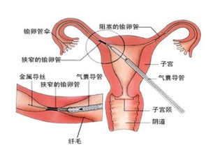 乳腺管道怎么疏通最快(乳腺管堵塞有什么好的方法可以通的)