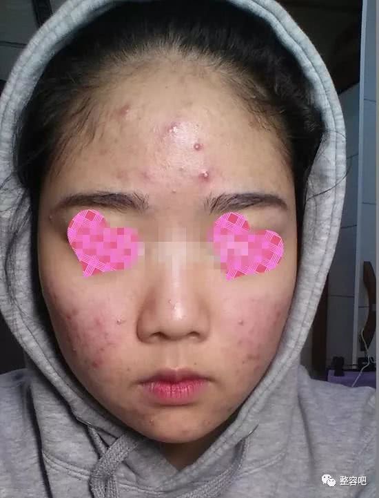 脸上血管瘤怎么疏通管道(脸上的血管瘤)